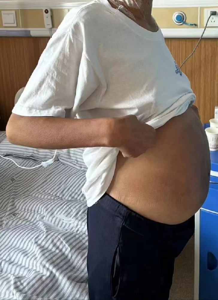 9 分钟！黄河科技学院附属医院这项技术让大腹“消失”！